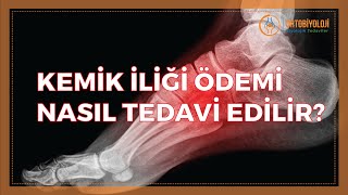 KEMİK İLİĞİ ÖDEMİ NASIL TEDAVİ EDİLİR [upl. by Euqinim]