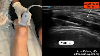 Ultrasound Guided Intraarticular Knee Injection [upl. by Sykleb]