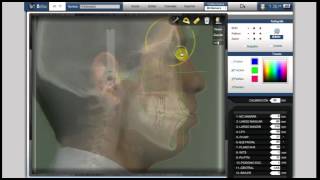 programa cefalometria CEFAX [upl. by Ajnotal]