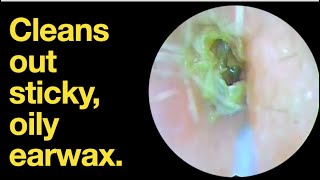 Cleans out sticky oily earwax ear wax removal  ear cleaning  ASMR  relaxation  relax [upl. by Shumway]