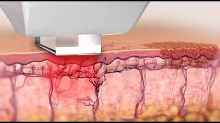 Revitalize Your Eyes with Lumecca IPL Animation The Journey to Soothing Dry Eye Syndrome [upl. by Traggat]