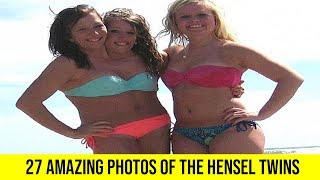 27 Photos of the Amazing Hensel Twins  LIST KING [upl. by Rettuc]