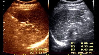 Granulomatous lesions of the spleen  Practical Ultrasonogram Spleen  Lymphoma Spleen [upl. by Jeraldine]