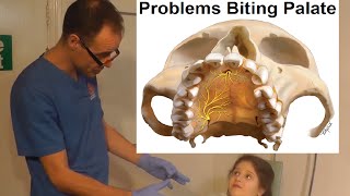 Problems Associated with Biting on Palate Roof of Your Mouth Maxilla by Dr Mike Mew [upl. by Taveda]