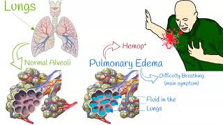 Pulmonary edema  Mechanism of action [upl. by Libre]