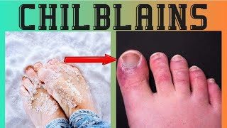 Chilblains causes symptoms treatment urduhindi [upl. by Pacifica845]