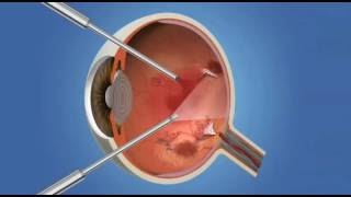 How to Remove Eye Floaters [upl. by Terle]