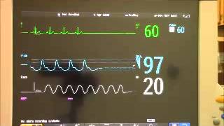 MP70 Asystole Alarm [upl. by Nims]