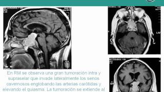 NeurorgsnetMacroadenoma de Hipófisis [upl. by Gahan]