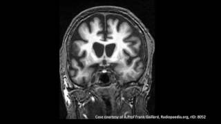 Huntingtons Disease [upl. by Fullerton]