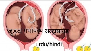 Dichorionic diamniotic twin pregnancy twin babies hindiurdu [upl. by Pirnot]