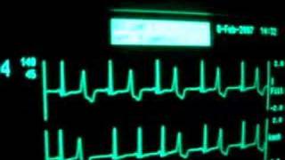 intensive care ecg with extrasystoles [upl. by Milore]