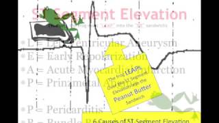 Teaching 12 Lead EKG STEMI or early repol [upl. by Trainor]