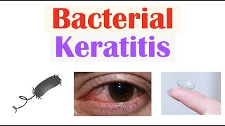 Bacterial Keratitis Eye Infection From Contact Lenses  Causes Symptoms Diagnosis Treatment [upl. by Llekcm]