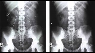 Abdomen  Radiographic Positioning [upl. by Anailil]