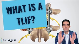 How I perform a TLIF and what to expect after [upl. by Eibba216]