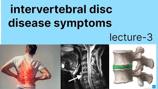 Intervertebral disc disease symptoms slip disc क्या होता हे [upl. by Ashla]