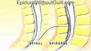 Animation of Difference Between Epidural and Spinal Techniques [upl. by Llertnad300]