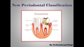 New Periodontal Classification [upl. by Nednal]