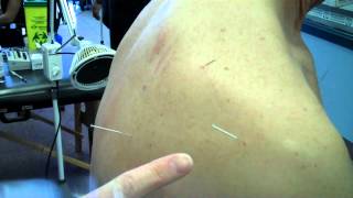 Acupuncture of the Shoulder Small Intestine Acupuncture Points [upl. by Aisanat]