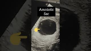 Early pregnancy Gestational sac yolk sac Amniotic sac embryo [upl. by Asaph]