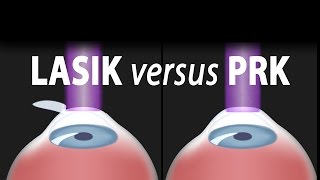 LASIK or PRK Which is right for me Animation [upl. by Esinek225]