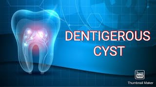 DENTIGEROUS CYST [upl. by Yendirb]