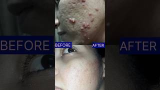 Acne Scars Before amp After Results acnescars skincare short [upl. by Ybok]