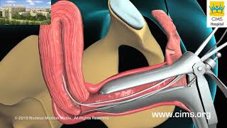 Endometrial Biopsy Hindi  CIMS Hospital [upl. by Bartolome]