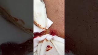 Big Cystic Acne Blackheads Extraction Blackheads amp Milia Whiteheads Removal Pimple Popping shorts [upl. by Admama]