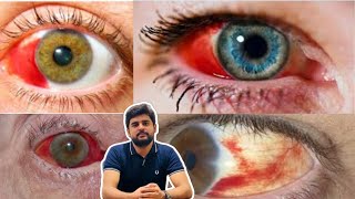 Subconjunctival hemorrhage eye blood education optometry drhashimjabbar subcribemychannel [upl. by Aronle]