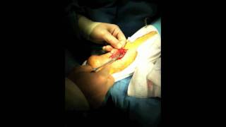 Achilles Tendon Rupture Repair Surgery  Houston Foot Surgeon [upl. by Refinney]