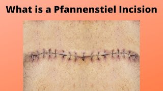 What is a Pfannenstiel Incision [upl. by Shaner11]