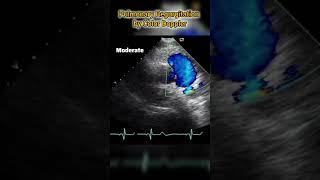 Pulmonary Valve Insufficiency estimation by color doppler Echocardiography [upl. by Inan835]