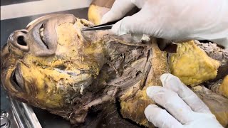 Triangles of neck amp its contentsdissection  MBBS 1st Year Anatomy  mbbs anatomy youtube [upl. by Sevart]