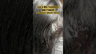 Lice removallicehow to remove lice from hairlice treatment CoimbatorechennaiKeralashortsvideo [upl. by Eihcra]