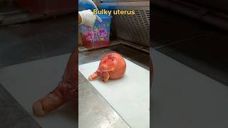 Bulky fibroid uterus பருமனான ஃபைப்ராய்டு கருப்பை  tissuefixation tissuepreparation histo [upl. by Elihu513]