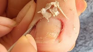 Video cleaning corners of toenails  part 49NhaNguyenPhanThiet [upl. by Ekusuy]