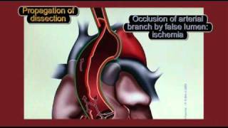 Physiopathology of aortic dissection [upl. by Ck357]