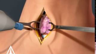 Tracheotomy  3D animation [upl. by Mandle]