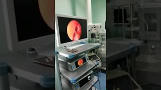 NASAL POLYP  ENDOSCOPIC SURGERY OF Nasal Polyp [upl. by Lanna]