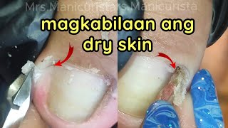 Toenail Ingrown Removal grabi magkabilaan ang Dry Skin ni ate [upl. by Enyrehtak]