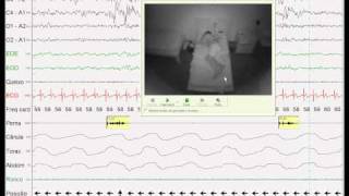 Periodic Limb Movements [upl. by Buckley]