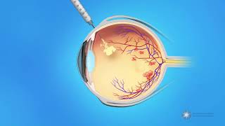 Eye Injections for Central Retinal Vein Occlusion CRVO [upl. by Temp328]