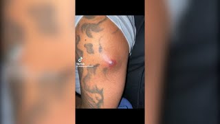 Popping huge blackheads and Pimple Popping  Best Pimple Popping Videos 158 [upl. by Domonic]