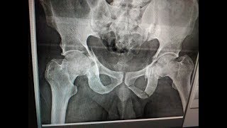 Acetabulum Percutaneous technique  Dr Ramprasad K MSORTHO AIIMS FAOA AUS A1 ORTHOCARE [upl. by Nolitta]