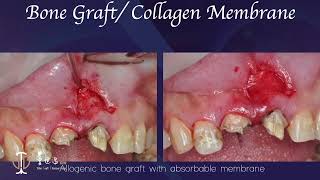 Restorative Crown Lengthening in Esthetic Zone amp Apicoectomy with Giuded Tissue Regeneration V [upl. by Nythsa]