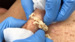 Stubborn Sac and Cyst Removal  CONTOUR DERMATOLOGY [upl. by Heddy]