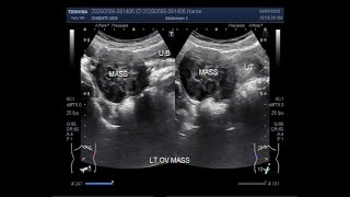 Ultrasound Video showing an Ovarian tumor [upl. by Eelyme]