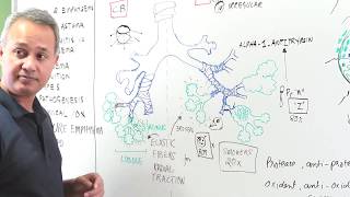 Emphysema  Clinical Presentation Diagnosis and Management [upl. by Etteyafal]